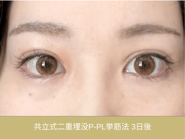 共立式二重埋没P-PL挙筋法の術後経過|施術3日後の目元