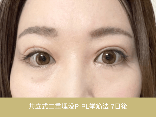 共立式二重埋没P-PL挙筋法の術後経過|施術7日後の目元