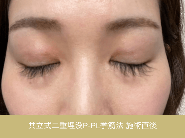 共立式二重埋没P-PL挙筋法の術後経過|施術直後の目元
