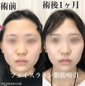 フェイスラインの脂肪吸引を受けた方の術前と術後1ヶ月の正面比較写真