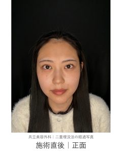 二重埋没法の施術直後。黒い背景の前で正面を向いた状態