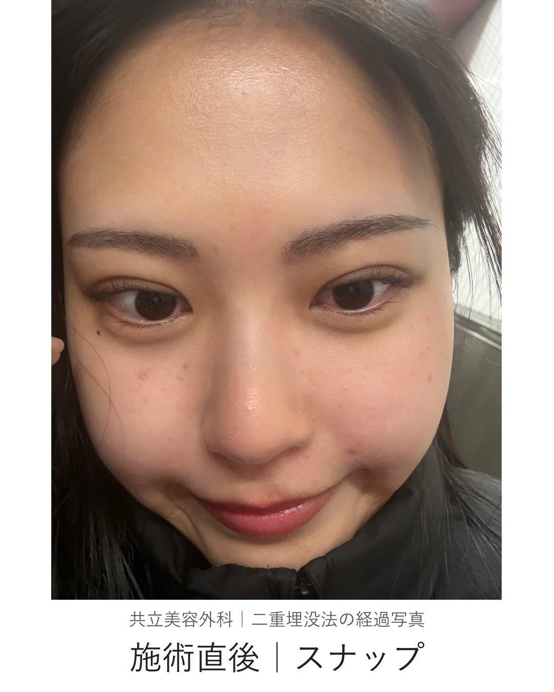 二重埋没法の施術直後に本人が撮影したスナップ写真