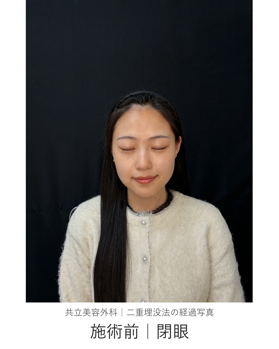 二重埋没法の施術前。目を閉じた状態を正面から撮影