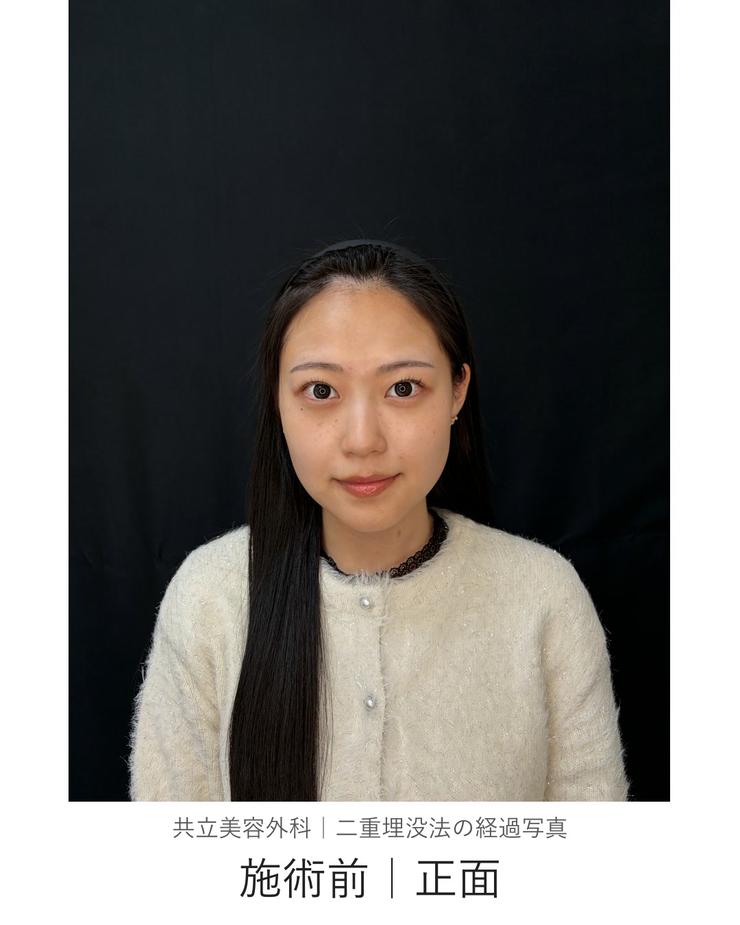 二重埋没法の施術前。黒い背景の前で正面を向いた状態