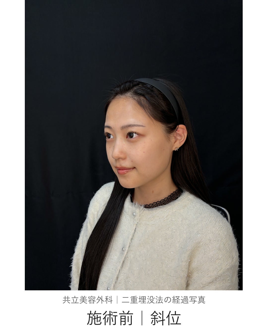 二重埋没法の施術前。斜めを向いた状態