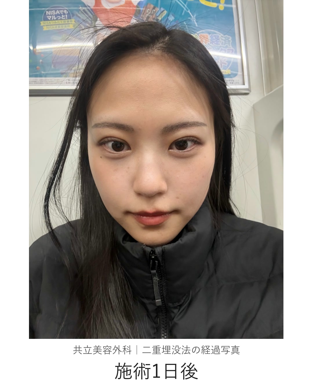 二重埋没法の施術1日後。外出先で本人が撮影した写真