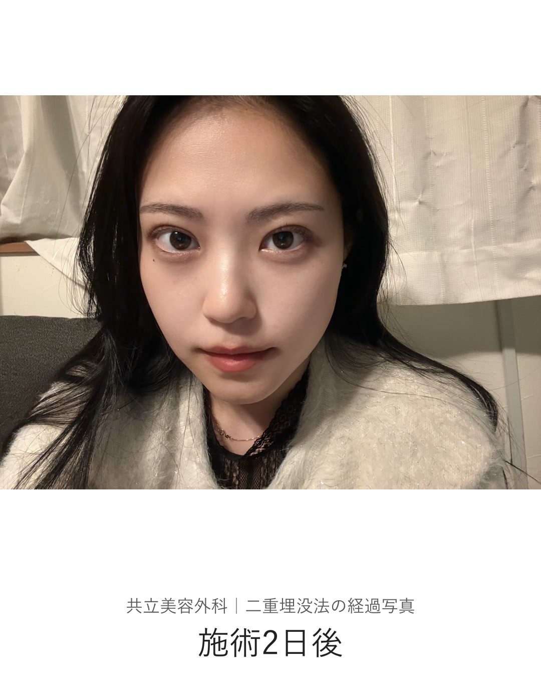 二重埋没法の施術2日後。室内で本人が撮影した写真
