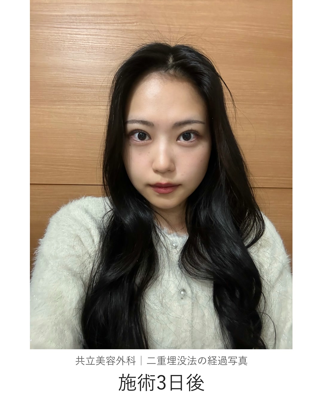二重埋没法の施術3日後。室内で本人が撮影した写真