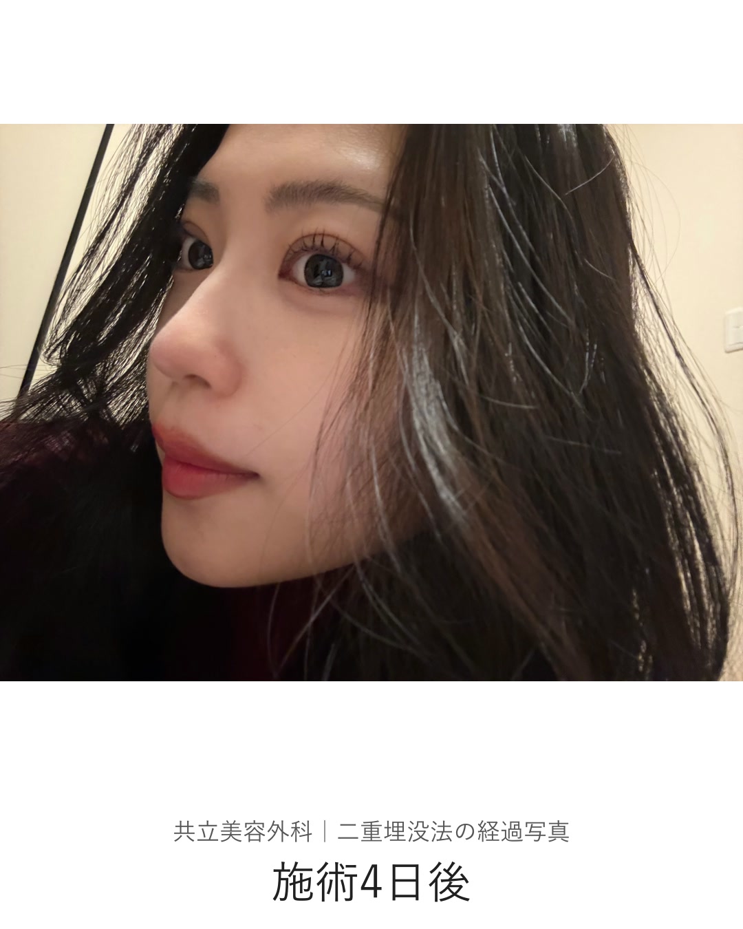 二重埋没法の施術4日後。斜めから近い距離で撮影した写真