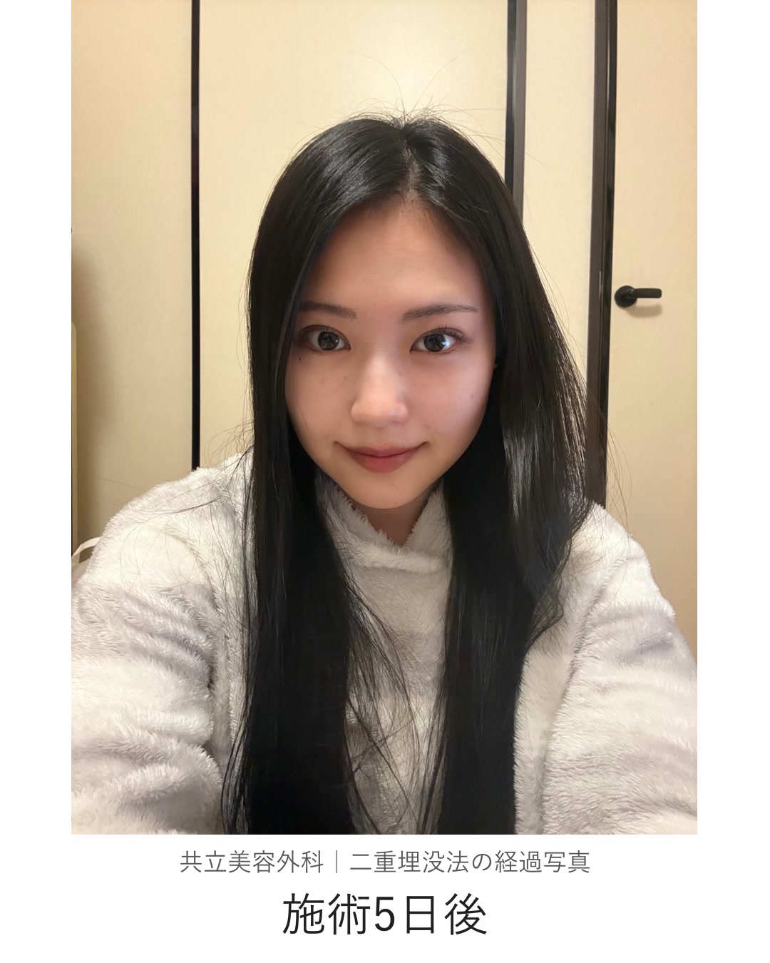 二重埋没法の施術5日後。自宅で本人が撮影した写真