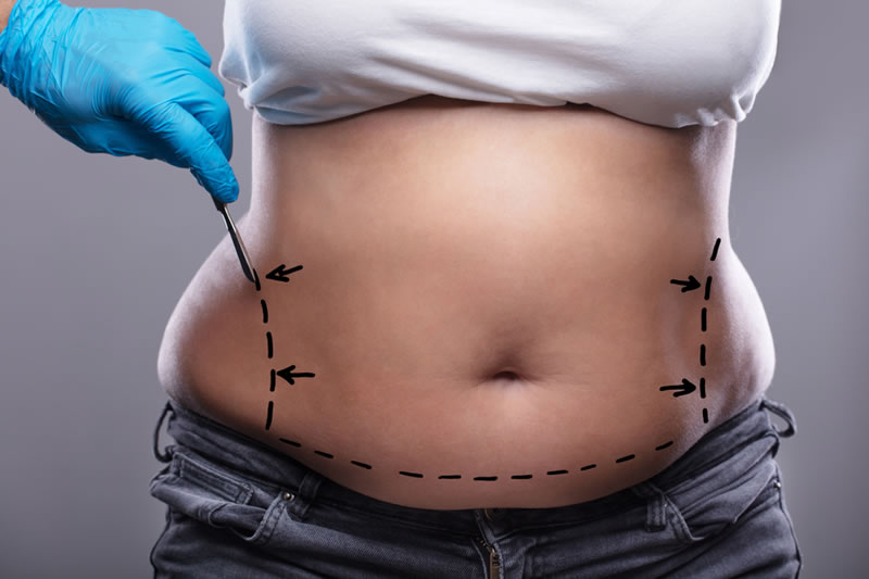 女性のお腹に脂肪吸引施術のラインを描く医師