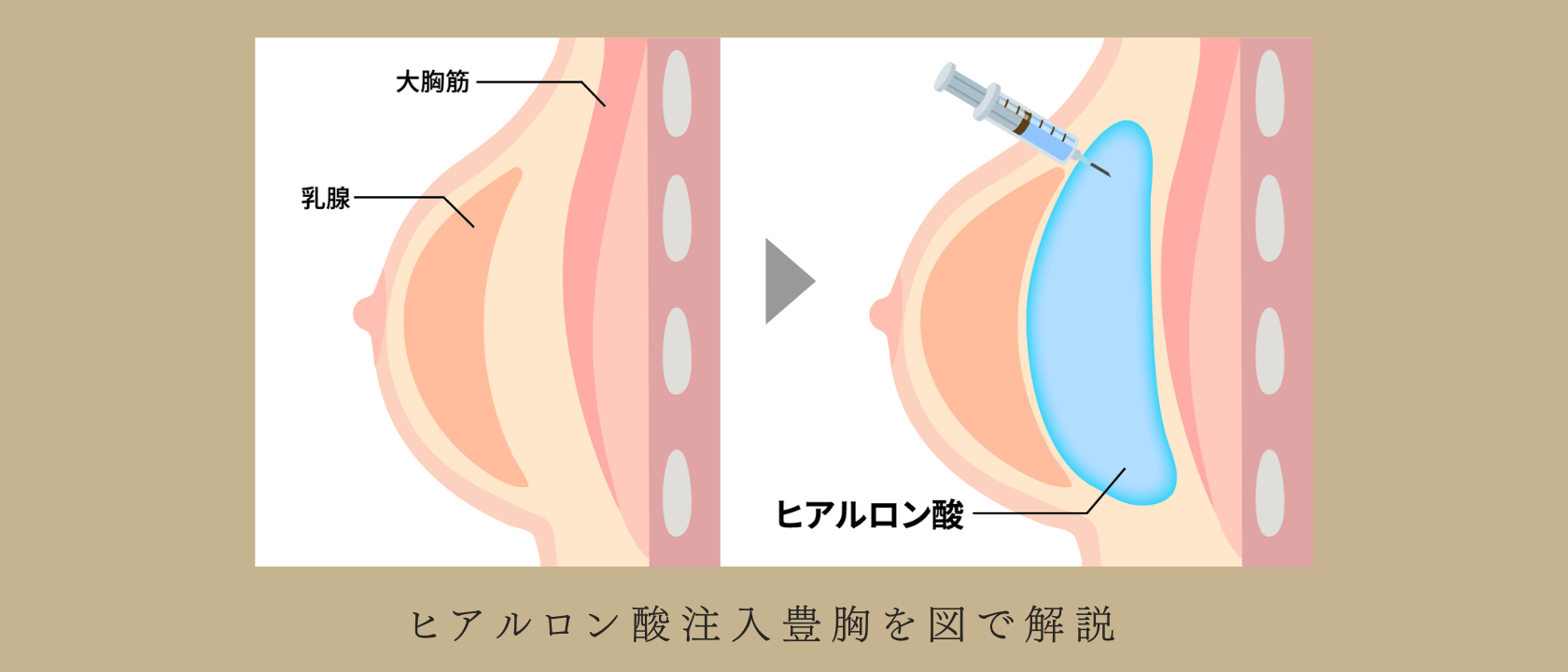 仙台でヒアルロン酸豊胸を受ける前に｜失敗例とクリニック選びのポイント | 地域別施術解説 | 美容整形・二重整形なら共立美容外科