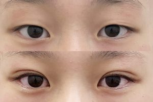 千葉院の二重の症例