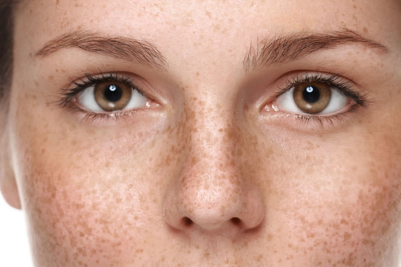 シミが多い女性