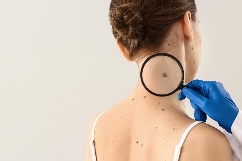 ほくろが気になっている女性