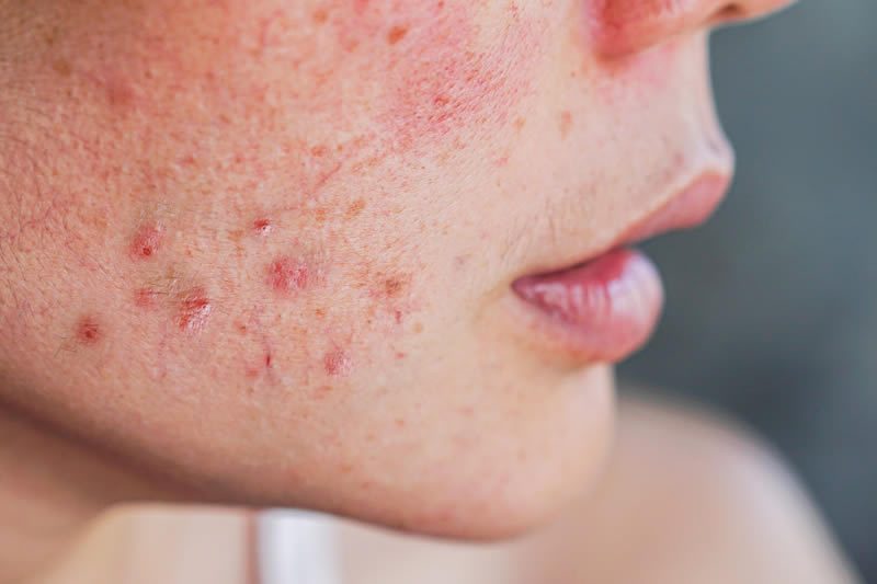 ニキビに困っている女性