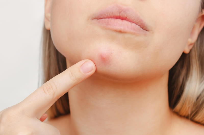 ニキビ跡が気になっている女性