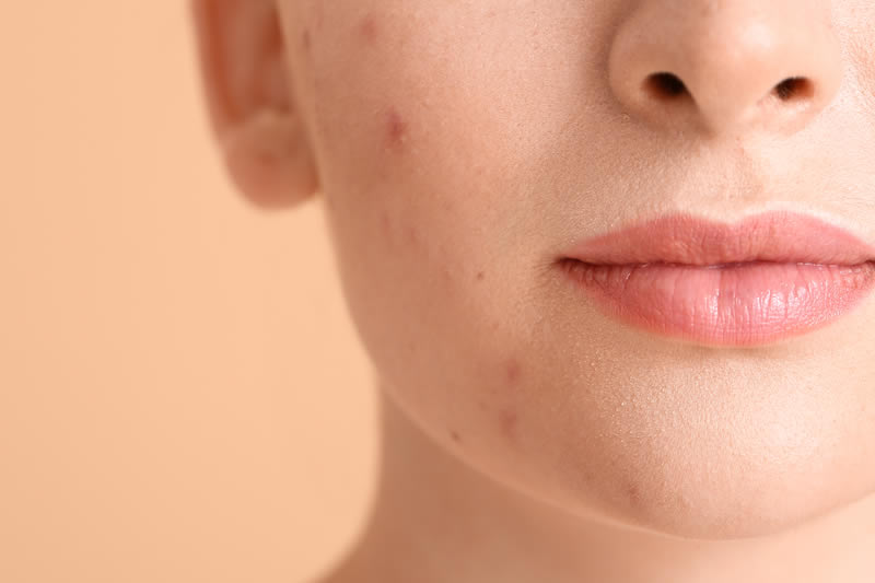 ダーマペンを考えている女性