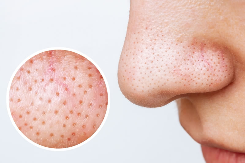 いちご鼻に悩む女性