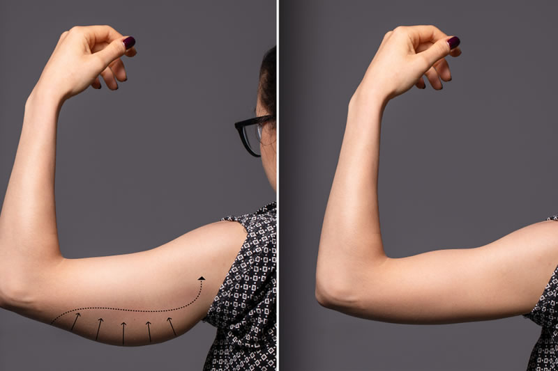 二の腕の脂肪吸引の術前術後の比較