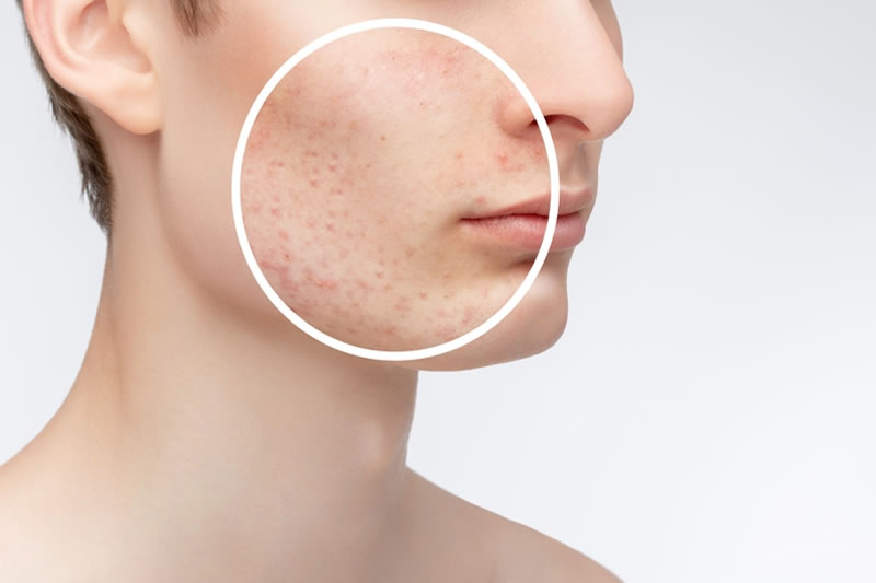 ニキビに悩んでいる男性