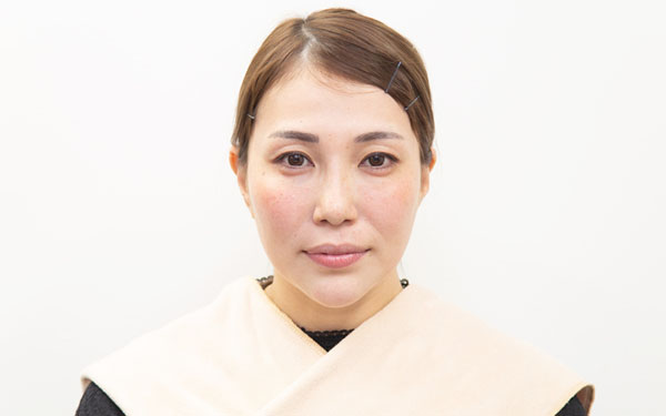 二重整形のカウンセリングから施術までの流れ ステップ3