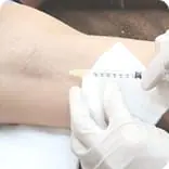 脇ボトックス