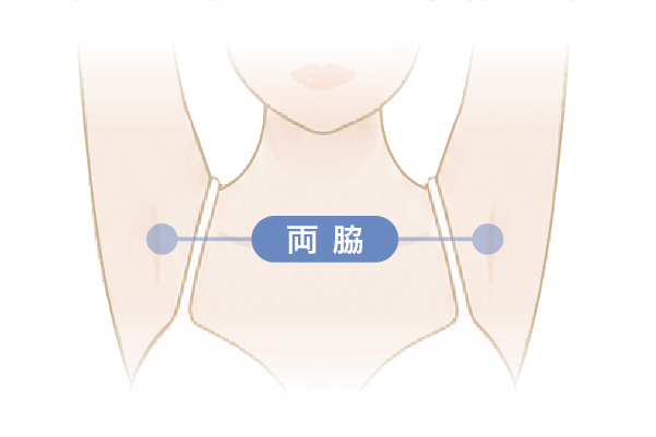 脇ボトックスの施術部位