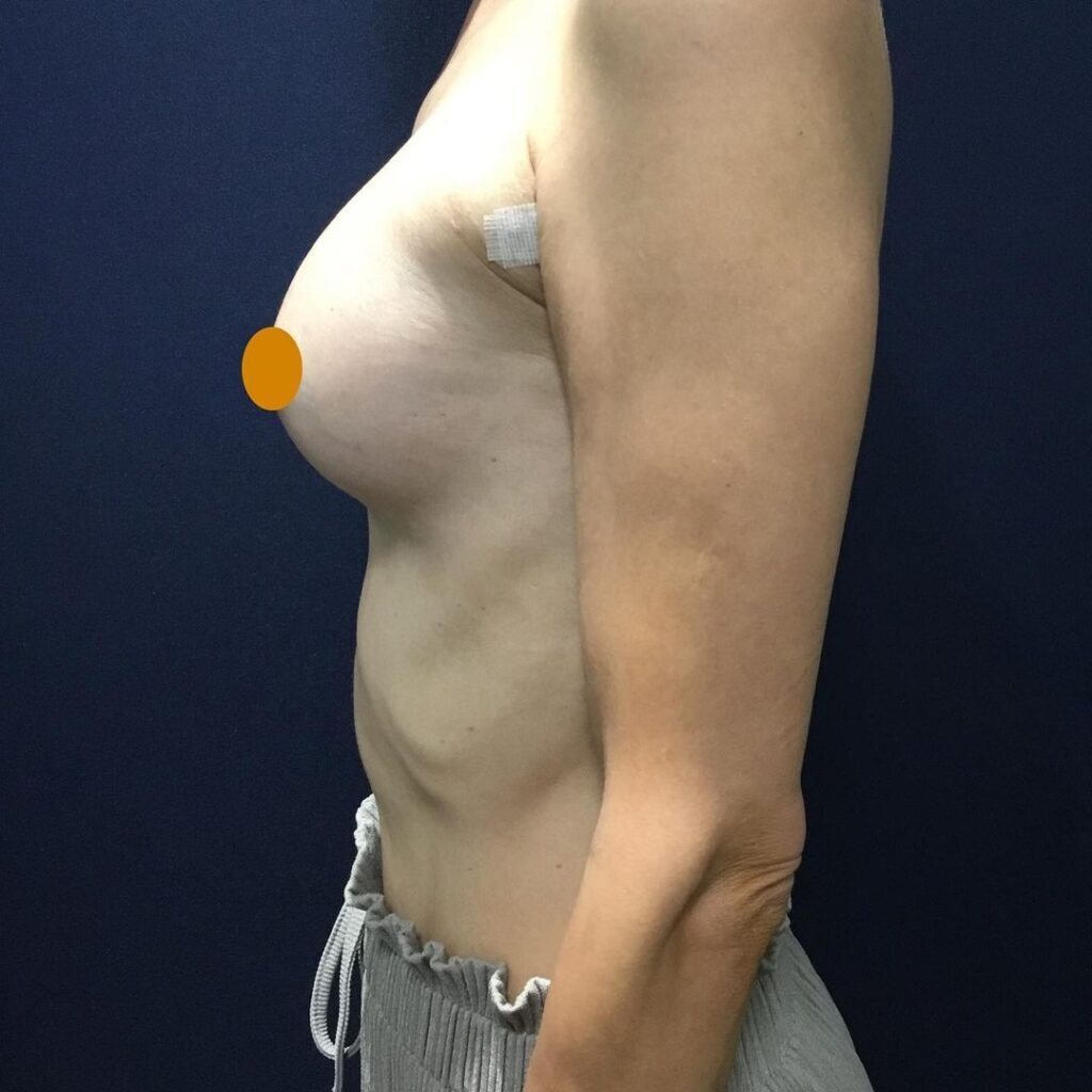 ヒアルロン酸豊胸の手術後の症例
