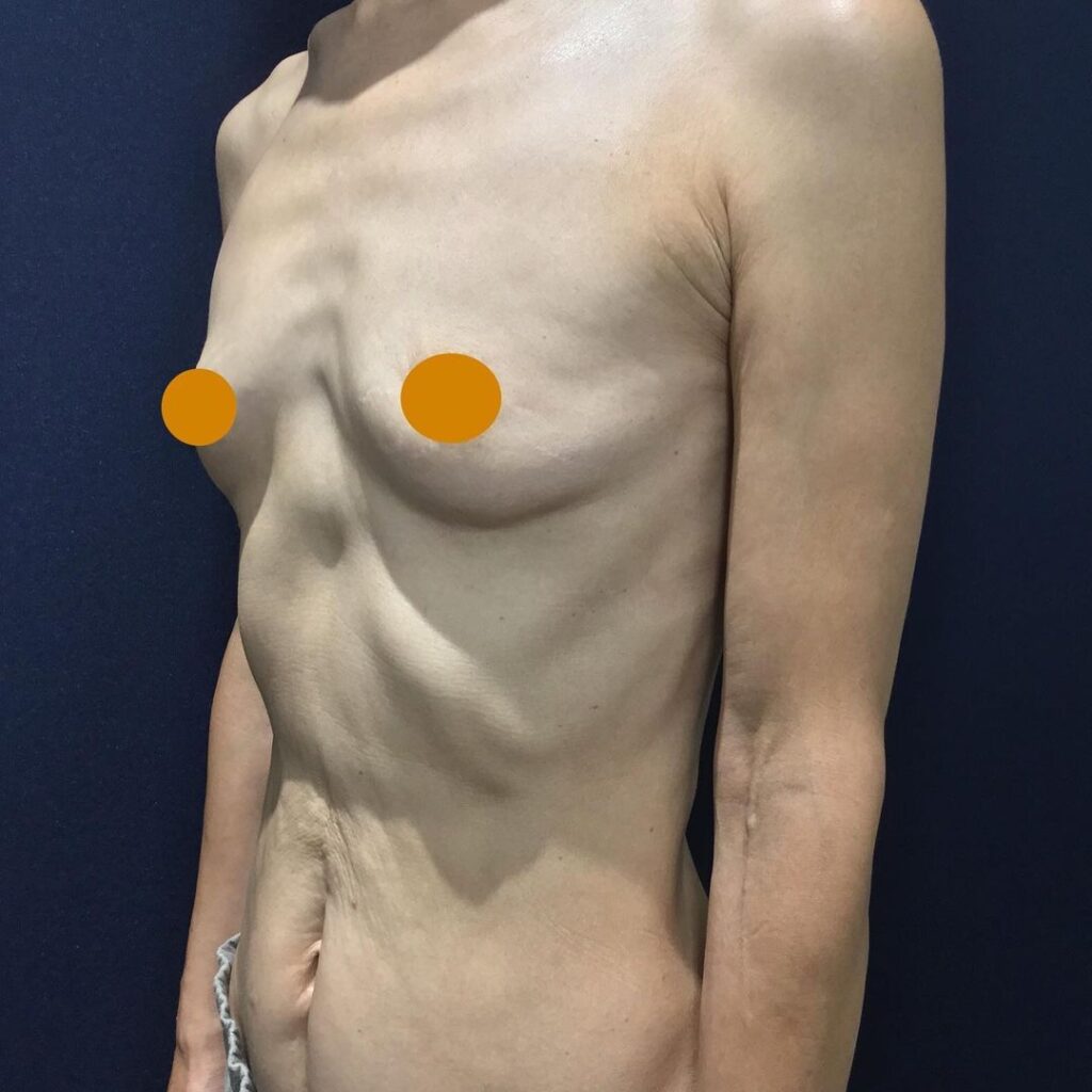 ヒアルロン酸豊胸の手術前の症例