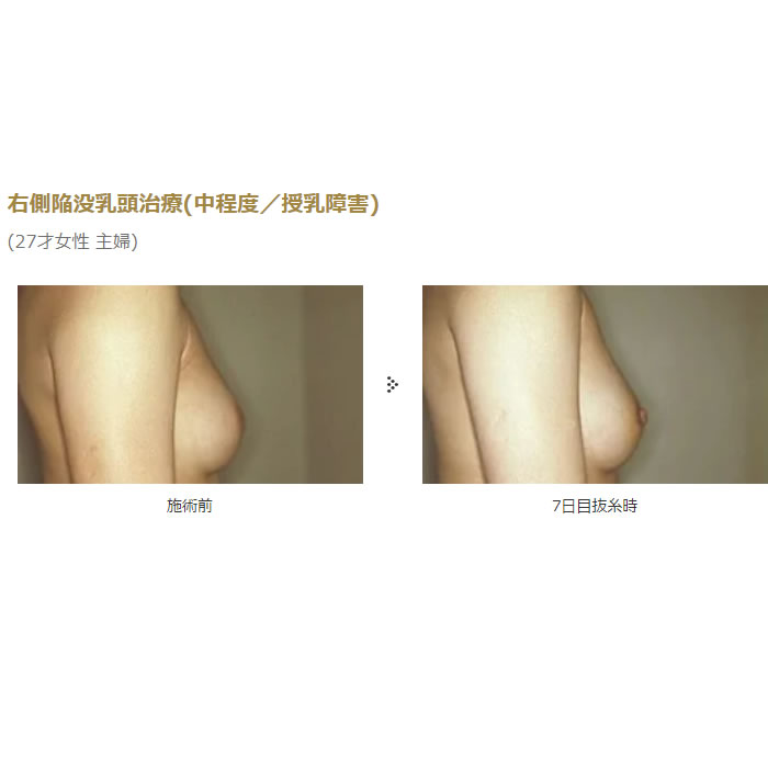 大阪本院の右側陥没乳頭治療の症例 (3)