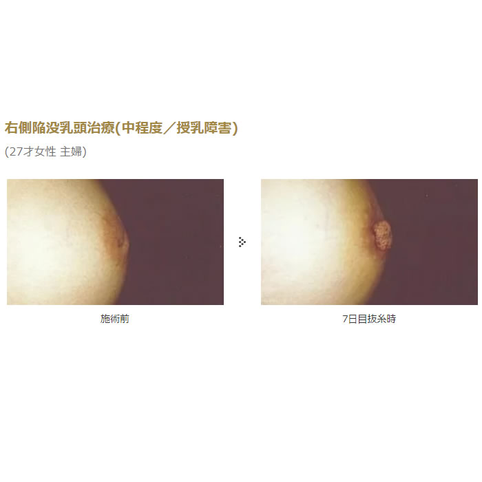 大阪本院の右側陥没乳頭治療の症例 (4)