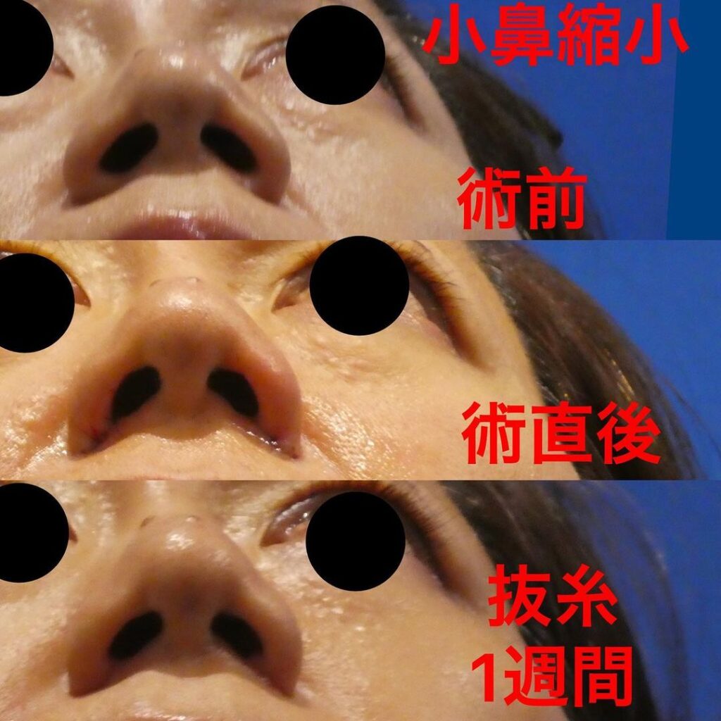 梅田院の小鼻縮小の症例 (1)