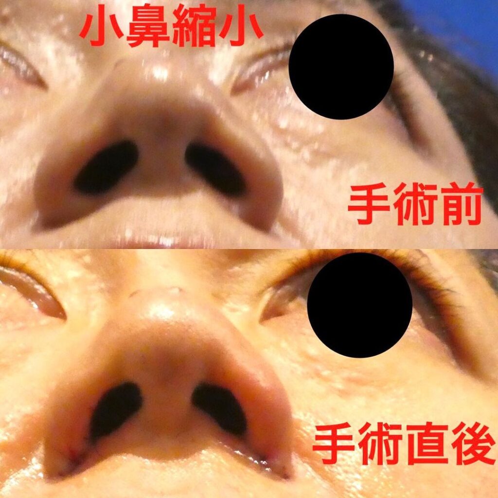 梅田院の小鼻縮小の症例 (2)