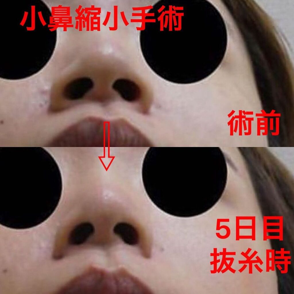 梅田院の小鼻縮小の症例 (3)