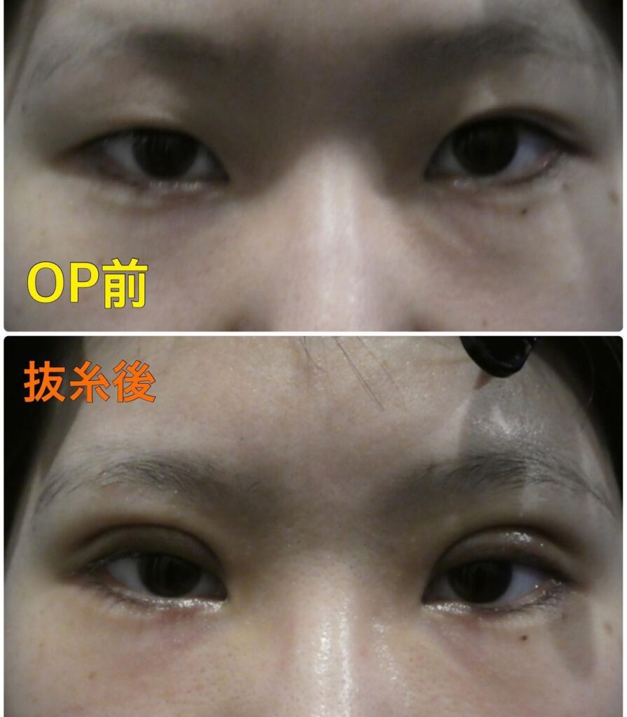 梅田院の眼瞼下垂の症例 (2)