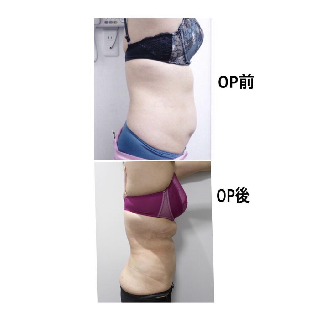 梅田院の脂肪吸引の症例 (3)