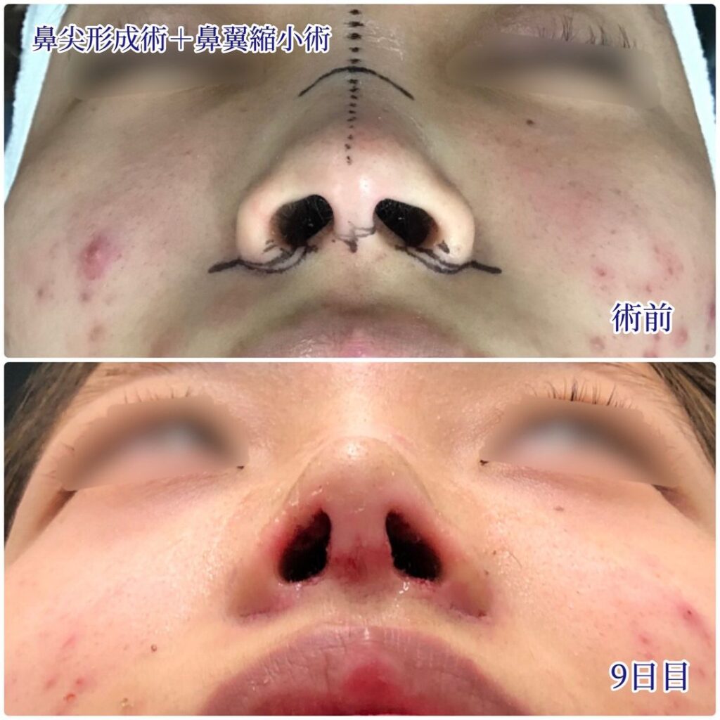 熊本院の鼻尖形成術と鼻翼縮小術の症例