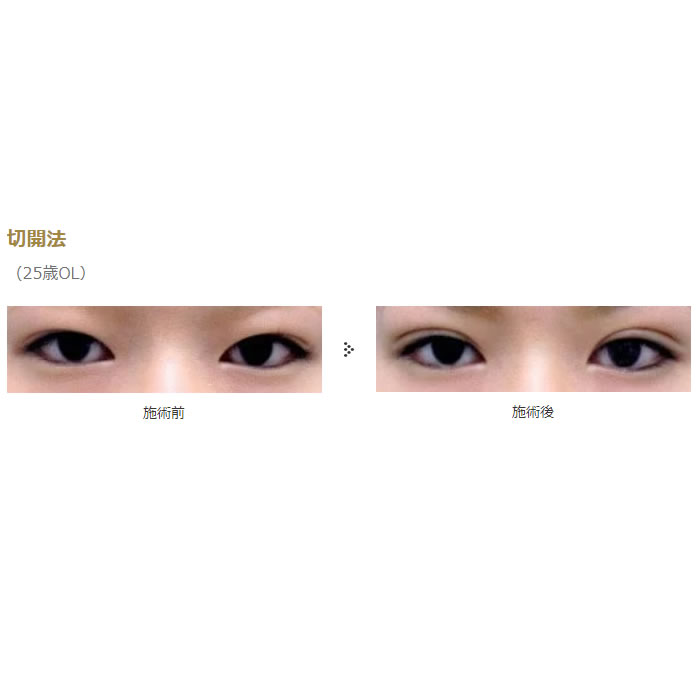 目の切開系の症例写真 (3)