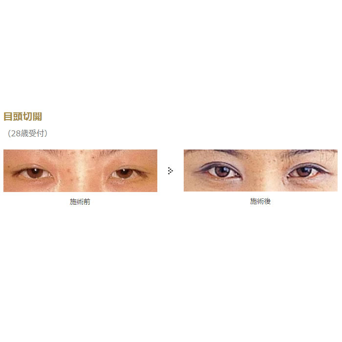 目の切開系の症例写真 (4)