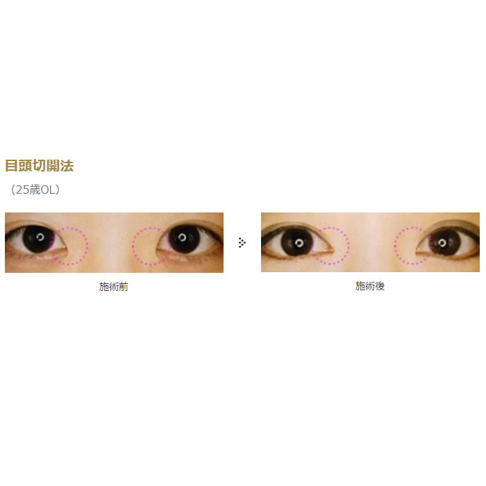 目の切開系の症例写真 (5)