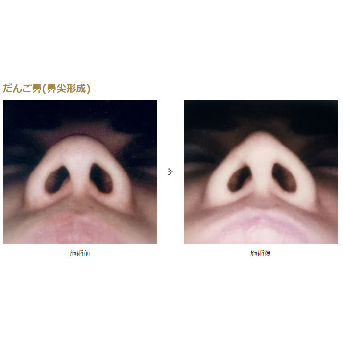 鼻の整形の症例写真 (10)