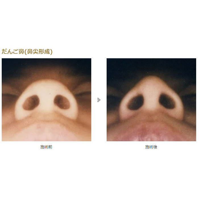 鼻の整形の症例写真 (11)