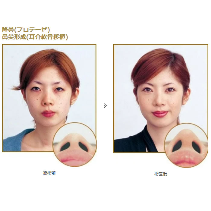 鼻の整形の症例写真 (3)
