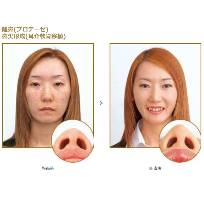 鼻の整形の症例写真 (4)