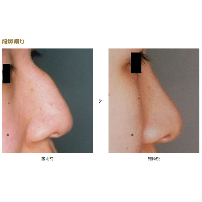 鼻の整形の症例写真 (7)
