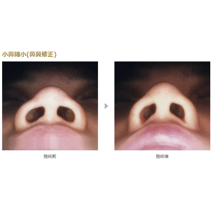 鼻の整形の症例写真 (9)