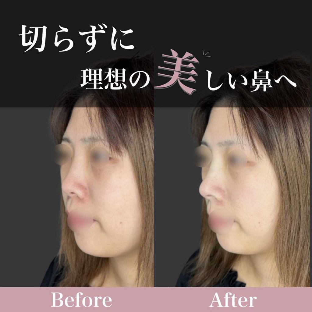 広島院の鼻整形の症例