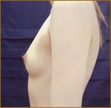 高度再生医療による幹細胞脂肪注入法豊胸術施術前　症例写真ケース1　横向き