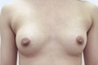 シンデレラ豊胸術の施術直後　症例写真1